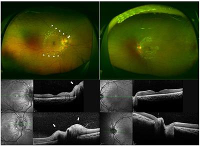 Pattern Visually Evoked Potentials in Japanese Girl With Optic Neuritis and Seropositive to Anti-myelin Oligodendrocyte Glycoprotein (MOG) Antibody